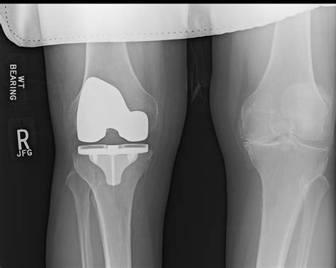 Some swelling and initial pain at the joint are normal after hip replacement. . Pictures of swelling after knee replacement